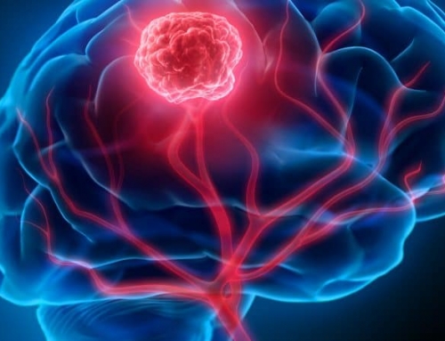 Câncer de Cérebro: quais os sintomas e como identificar
