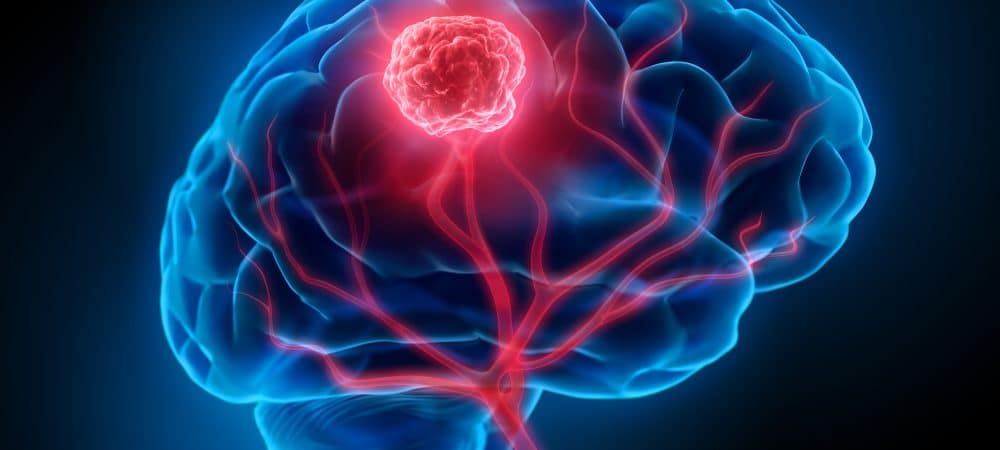 Câncer de Cérebro: quais os sintomas e como identificar