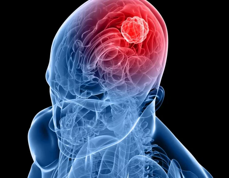 dr.consulta-cancer-no-cerebro-2-1024x576